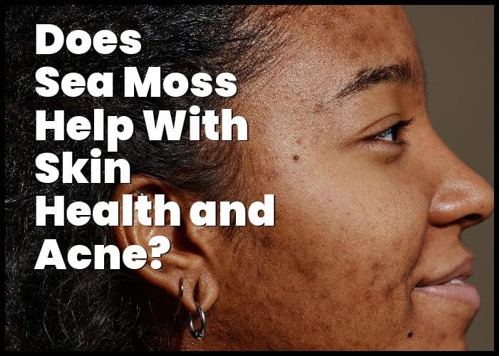 Sea Moss for Acne: How This Superfood Can Help Clear Up Your Skin